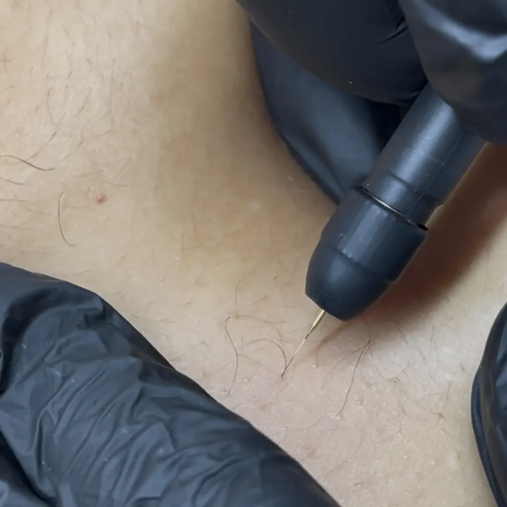 Traitement électrolyse sur peau clair